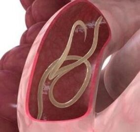 Los gusanos redondos son bastante comunes en el intestino humano. 