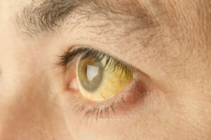 coloración amarillenta del blanco de los ojos